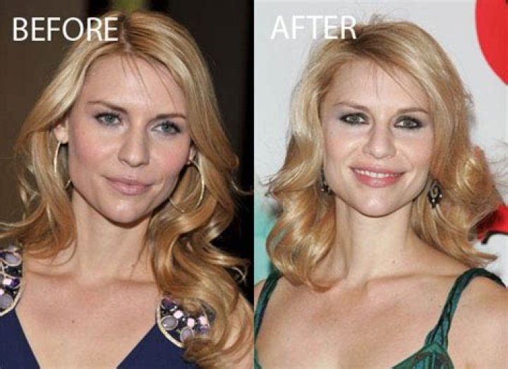 Claire Danes Plastic Surgery Before and After
